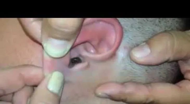Sentía un fuerte dolor dentro del oído? Cuando lo veas quedará asombrado (VIDEO)