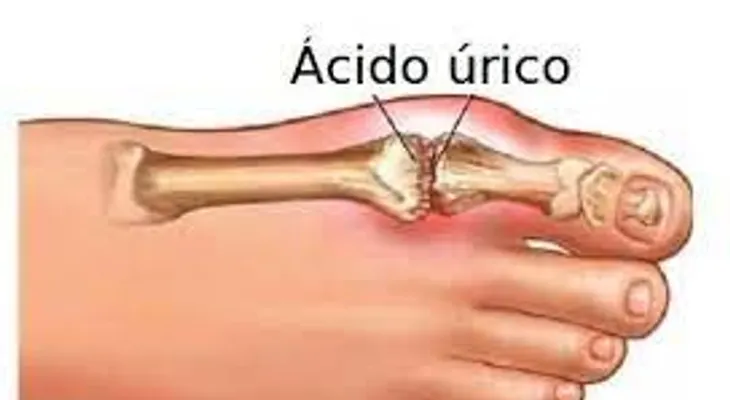  Elimina el ácido úrico con solo 2 cebollas: Cómo hacerlo; DIETA 