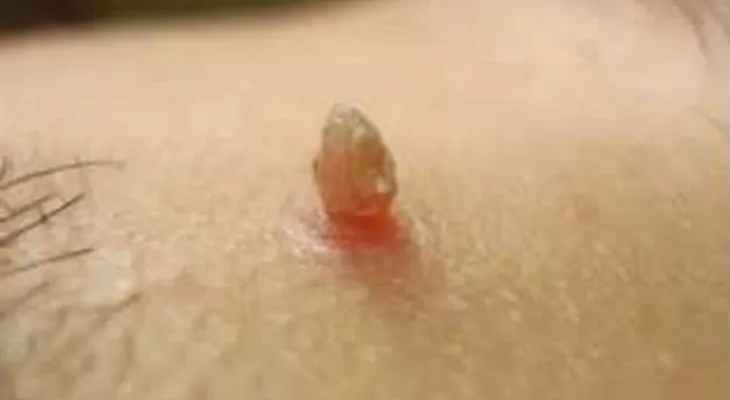 Remedio para quitar una verruga de la piel para siempre (VIDEO)