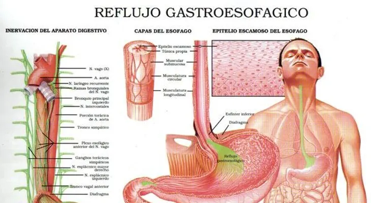 Las causas y síntomas del reflujo gástrico