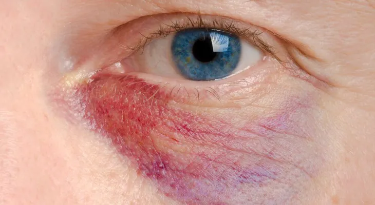 Los mejores remedios para mejorar un ojo morado