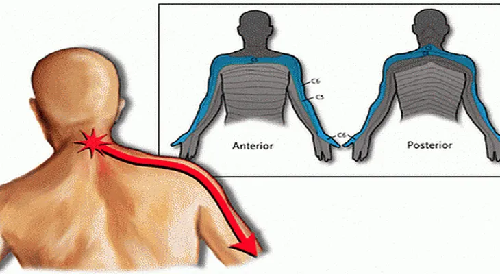 Cervicobraquialgia: El dolor que va del cuello hasta el brazo...Entérate de más!!