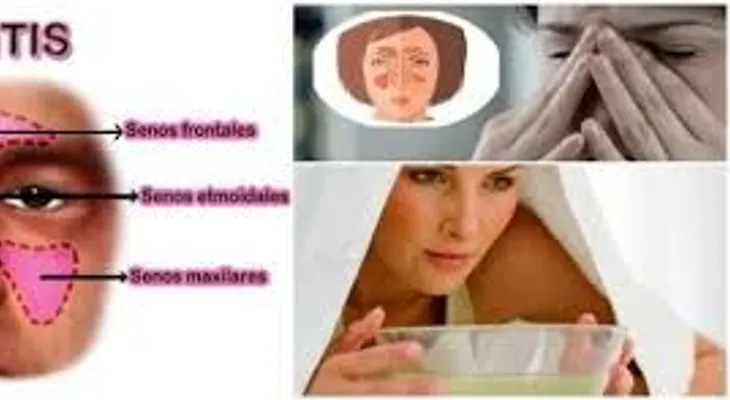 La sinusitis; 3 remedios caseros