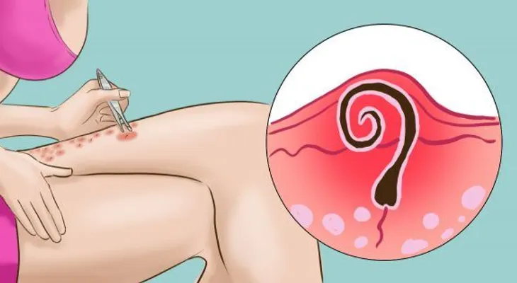 6 excelentes métodos para eliminar los vellos encarnados.