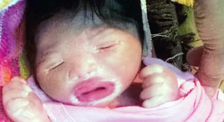 Nace la niña de plástico, un bebé con un rarísimo síndrome y cuya vida está en peligro