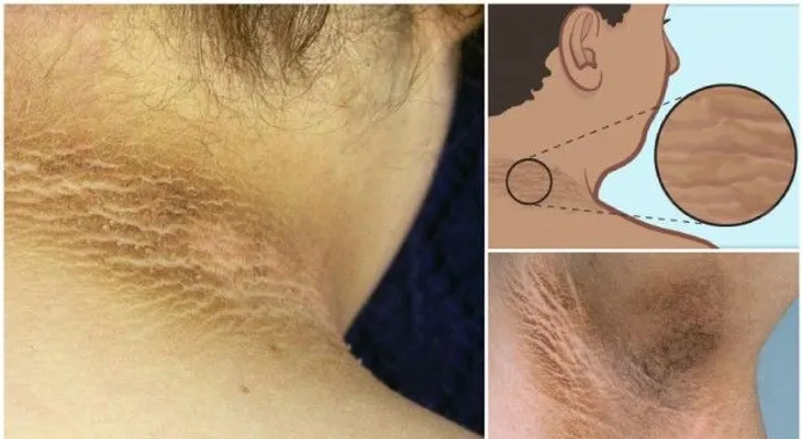 Con este remedio, en 5 días blanquearás tus axilas, rodillas y cuello