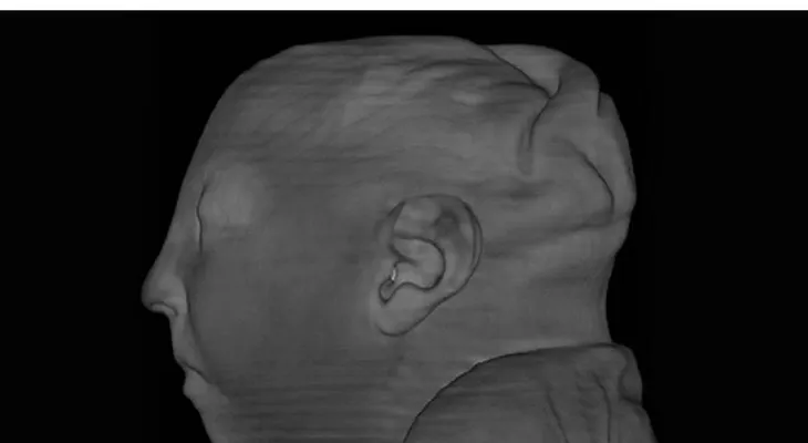 Los científicos ven por primera vez un cerebro de bebé atrofiado por el virus del Zika