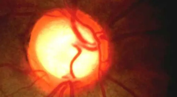  Grupo Hospiten realiza campaña de prevención por Día Mundial del Glaucoma