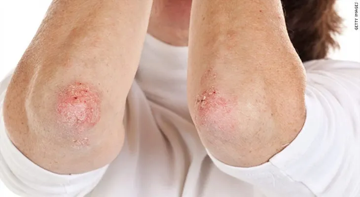 Mexicano crea un jabón artesanal que combate la psoriasis