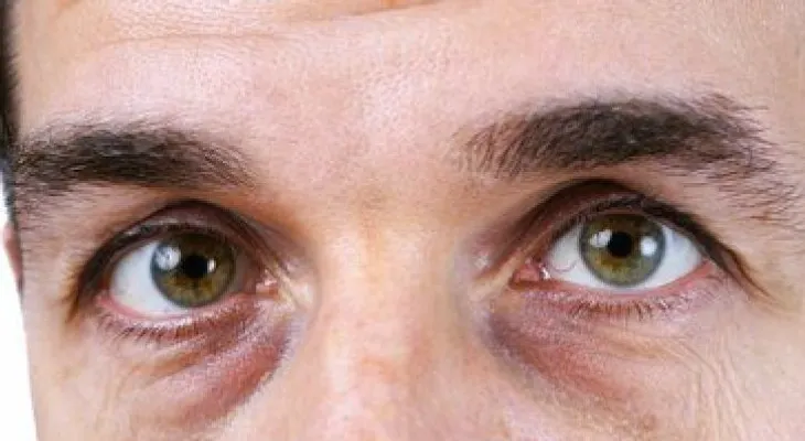 4 soluciones naturales para acabar con las ojeras