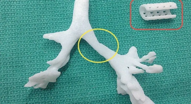 Taiwán trasplantará la primera tráquea impresa en 3D del mundo