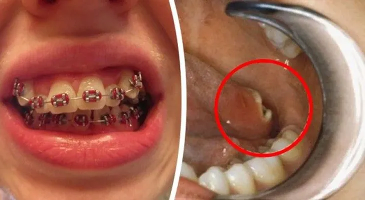 PELIGRO!! Cientificos aseguran que todo el que tenga brackets tendrá cancer