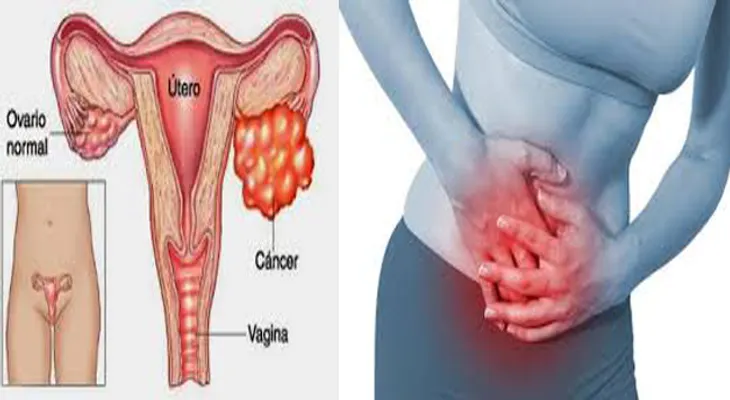 Doctora revela haber curado a muchas mujeres de cáncer uterino con solo 3 hierbas