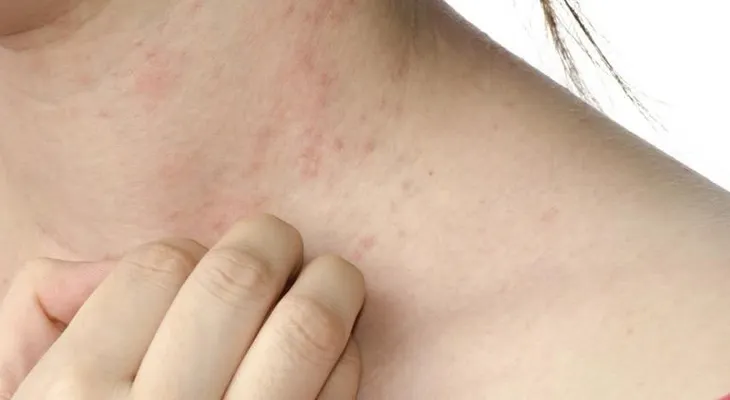 Fármaco disminuye la inflamación de la piel en adultos con dermatitis