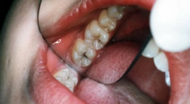 Esto elimina las caries en 20 minutos y un odontólogo nunca de lo dirá 