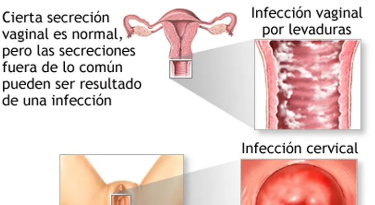 Causas y remedios para el flujo vaginal blanco - leucorrea