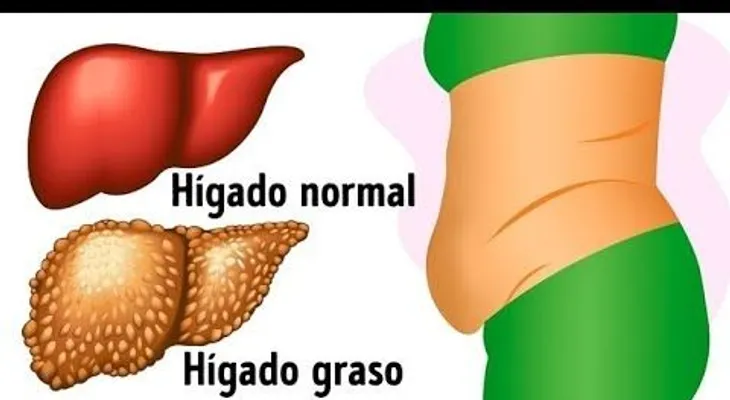 Estas 10 señales te indican que tu hígado está lleno de toxinas