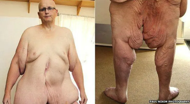 El ex hombre más gordo del mundo que se quitó 25 kilos de piel para caminar mejor
