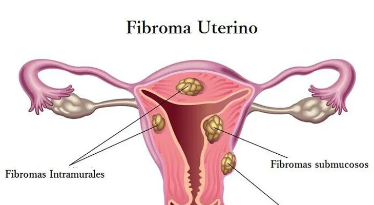 Advierten sobre tratamiento de fibroma uterino 
