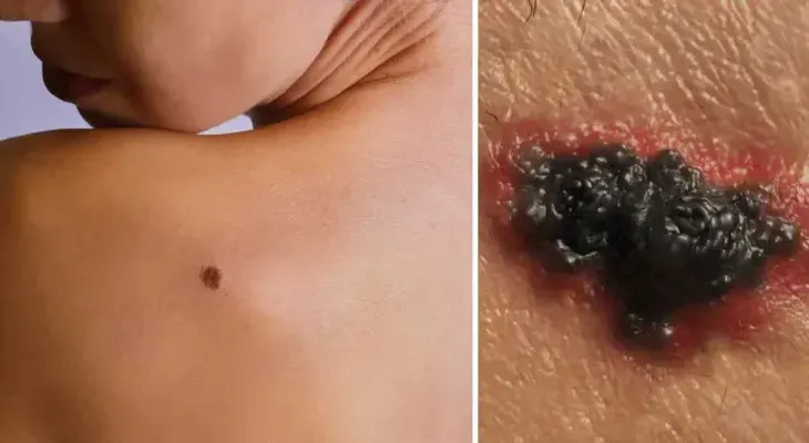 Descubren un mecanismo que causa la metástasis del melanoma y cómo frenarlo