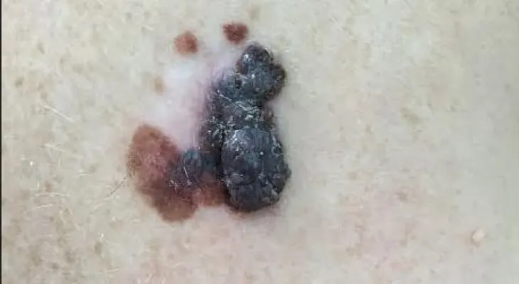Proteja su piel y evite la aparición del melanoma