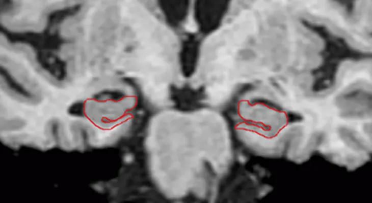 Ausencia de encogimiento cerebral puede predecir quién desarrolla demencia