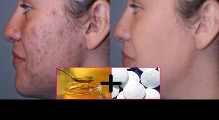 Lucirás como una princesa o un príncipe: peeling fácial con aspirina y miel durante 10 minutos. Luego mírate al espejo