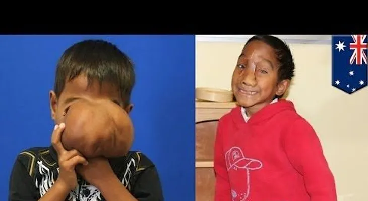 Vídeo: Remueven de rostro de un hombre un gigante tumor 