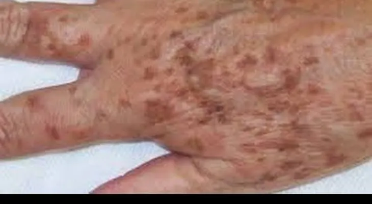 Un remedio que funciona para eliminar las manchas de las manos, por edad o por el sol