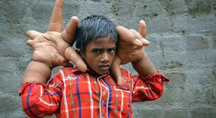 Un niño indio con manos gigantes sorprende a la comunidad médica