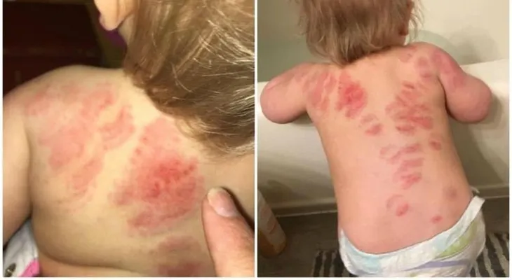 ¿La guardería sería un lugar seguro?; descubrió que su bebé fue mordido más de 25 veces 