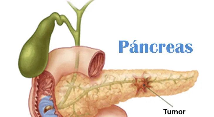  5 señales que si las ignora te puede desarollar un cáncer de páncreas