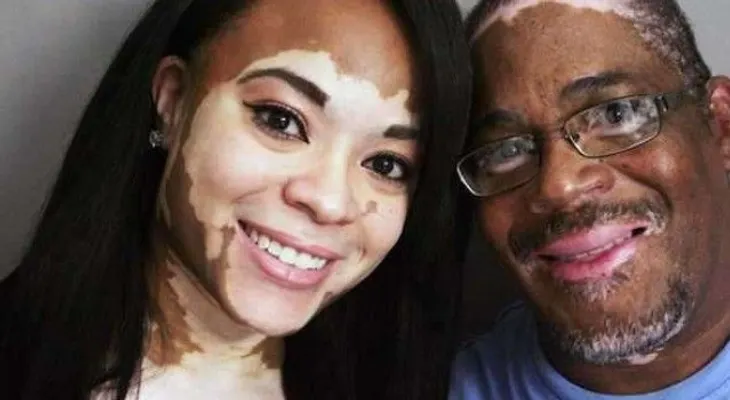 La Humanidad Celebra: Médicos Cubanos logran la cura del Vitíligo
