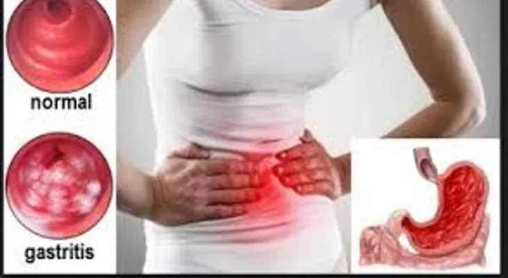 Este remedio elimina para SIEMPRE la gastritis y la acidez