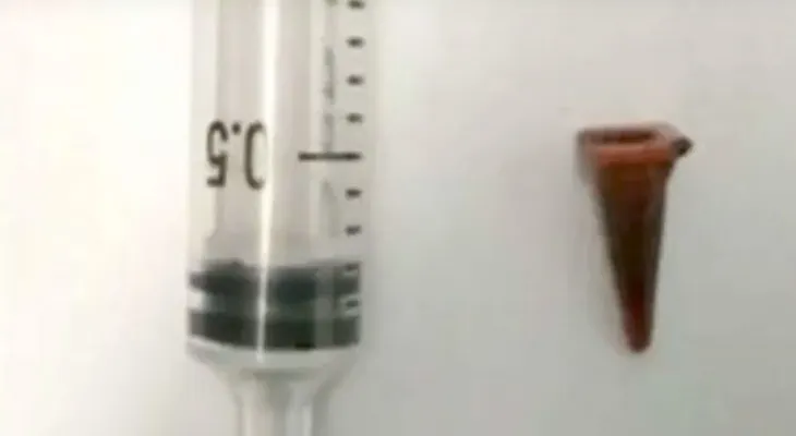 Un caso insólito: un hombre tenía hace 40 años, un cono plástico en su pulmón