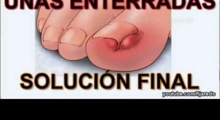 Solución sin dolor de uñas enterradas (Video)