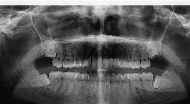 La periodontitis podría ser un signo precoz de una diabetes no diagnosticada