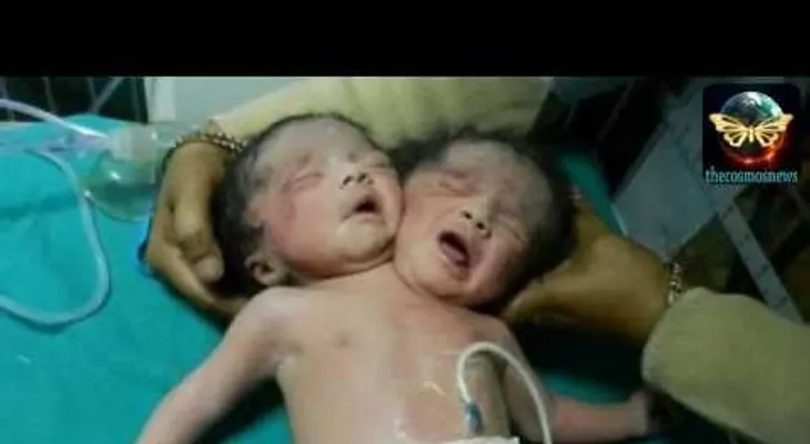 Video: Nacen Siameses con un sólo cuerpo y dos cabezas en la India 
