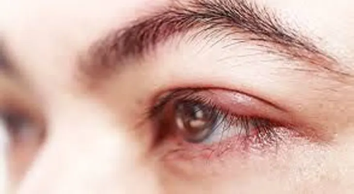 Entérate por qué se te hinchan los ojos