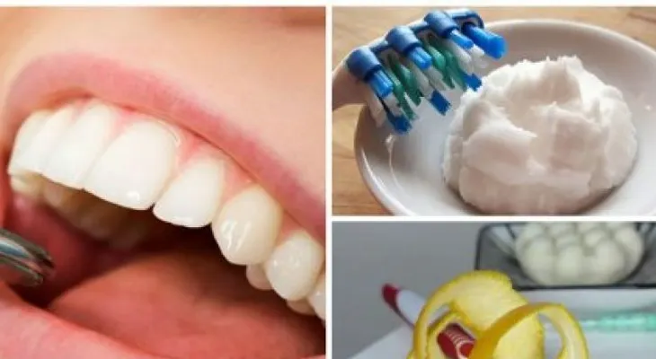 6 trucos caseros para remover el sarro acumulado en los dientes