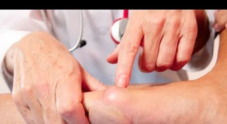 Cómo eliminar el ácido úrico de tu cuerpo de manera muy rápida; remedios 