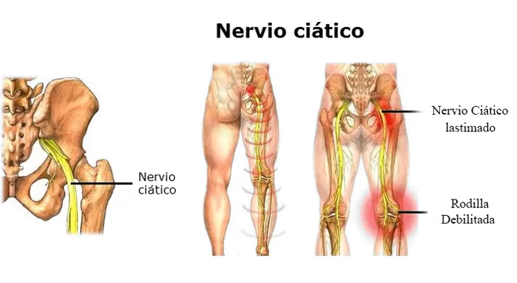 Desbloquear el dolor del nervio ciático en 2 minutos y parar el dolor