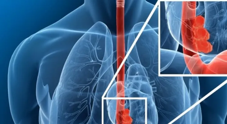 Cáncer de esófago es curable si se diagnostica a tiempo