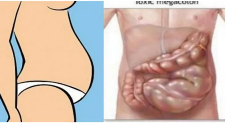 Si tu vientre está hinchado no es gordura, esto es lo que tienes...