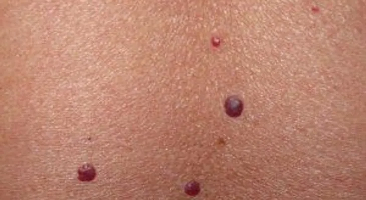 Los puntos rojos en la piel