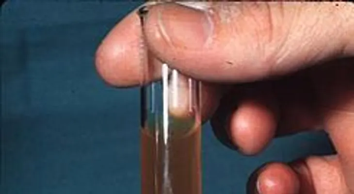 Remedio natural para la hematuria (sangre en la orina)