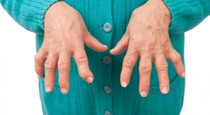 6 cosas que debes saber de la artritis reumatoide