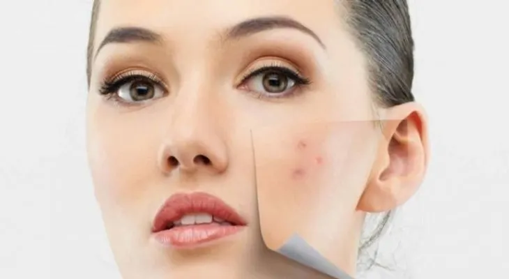 Seis remedios para quitar las manchas en la piel