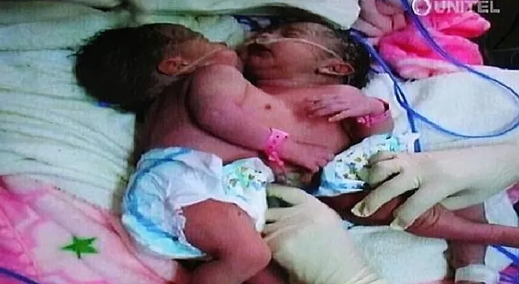 Nacen siamesas unidas por el corazón en Bolivia