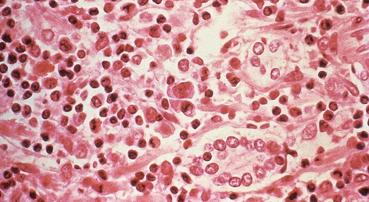  En este país un virus mortal ha aumentado su incidencia en un 81 por ciento